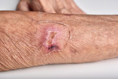 Why Your Skin Itches During Lymphedema (and What Can Help)